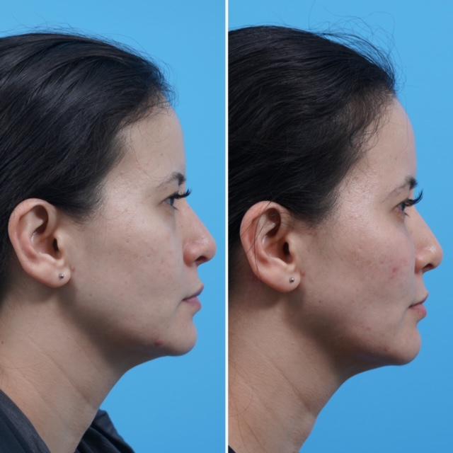 restylane and juvederm